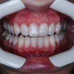 Photo bleaching