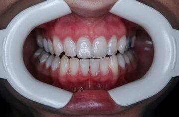 Photo bleaching