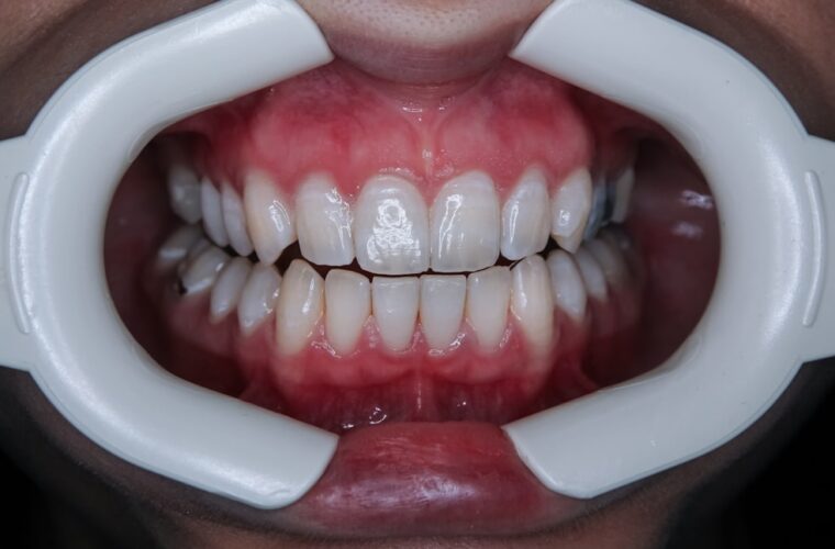 Photo bleaching